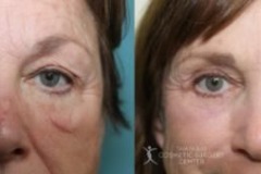 before-after-festoon-18