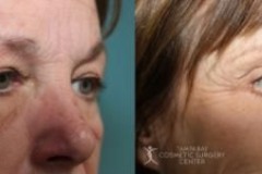 before-after-festoon-19
