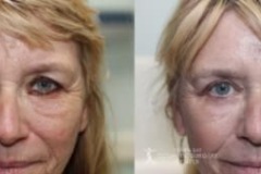 before-after-festoon-20