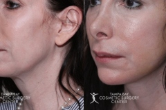 before-after-festoon-11