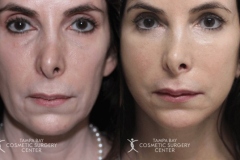 before-after-festoon-12