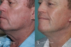 before-after-festoon-13