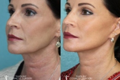 before-after-festoon-14