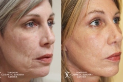 before-after-festoon-15