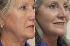 before-after-festoon-16