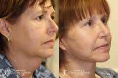 before-after-festoon-3