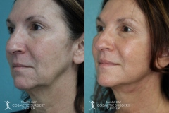 before-after-festoon-5