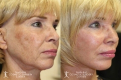 before-after-festoon-6