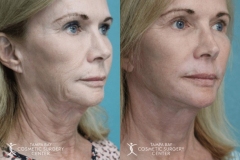 before-after-festoon-7