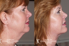 before-after-festoon-8