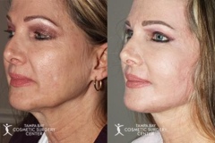 before-after-festoon-10