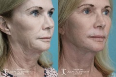 before-after-festoon-7