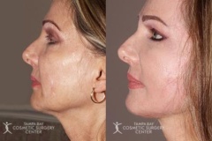 before-after-festoon-9