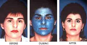 Obagi Blue Peel Before and After Photos