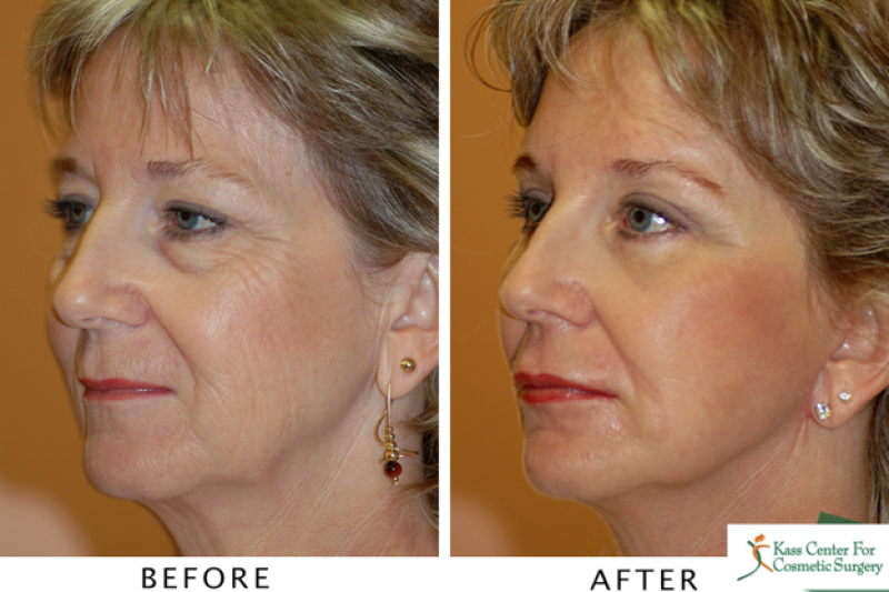 Is a Weekend Facelift Right For You?