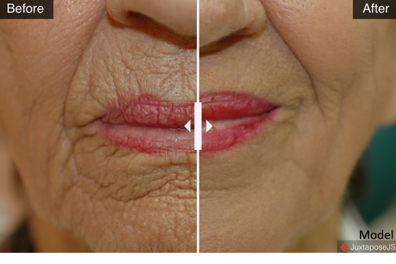 Deep Facial Resurfacing - Hetter Peel