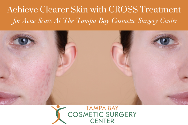 Achieve Clearer Skin with CROSS Treatment for Acne Scars At The Tampa Bay Cosmetic Surgery Center