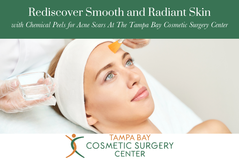 Rediscover Smooth and Radiant Skin with Chemical Peels for Acne Scars At The Tampa Bay Cosmetic Surgery Center
