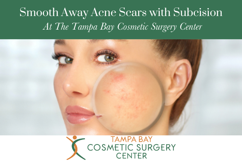 Smooth Away Acne Scars with Subcision At The Tampa Bay Cosmetic Surgery Center