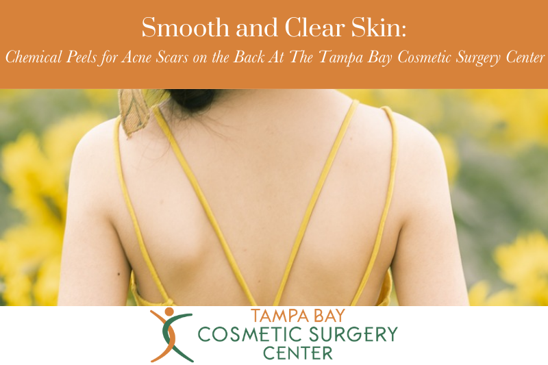 Smooth and Clear Skin Chemical Peels for Acne Scars on the Back At The Tampa Bay Cosmetic Surgery Center