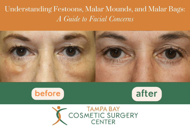 Understanding Festoons, Malar Mounds, and Malar Bags: A Guide to Facial Concerns